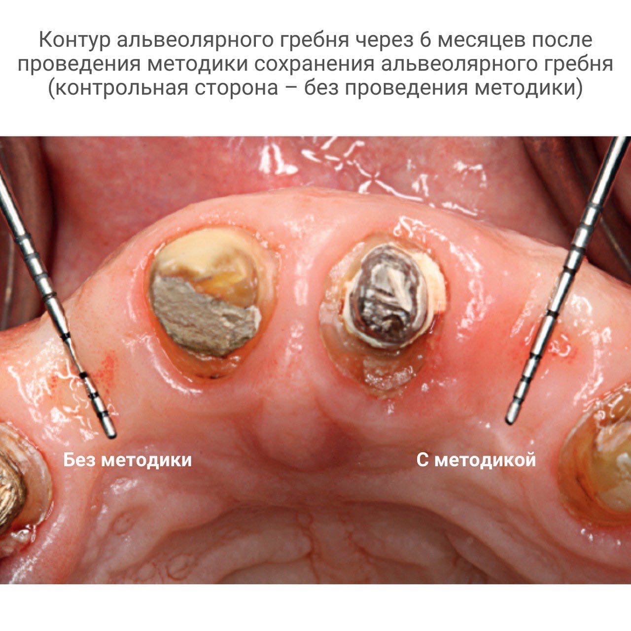 Методика сохранения альвеолярного гребня